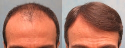 Mens Hairline Gallery