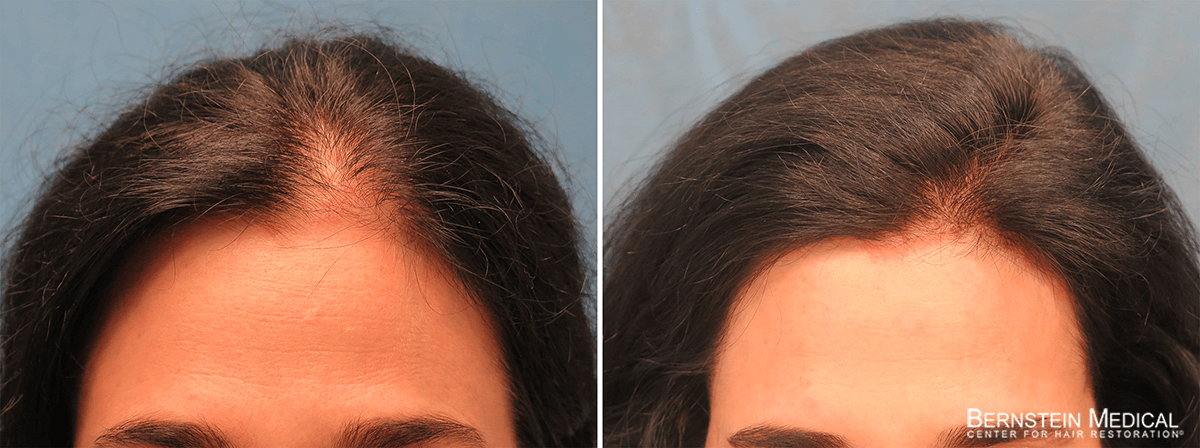 Bernstein Medical - Patient ABN Before and After Hair Transplant Photo 