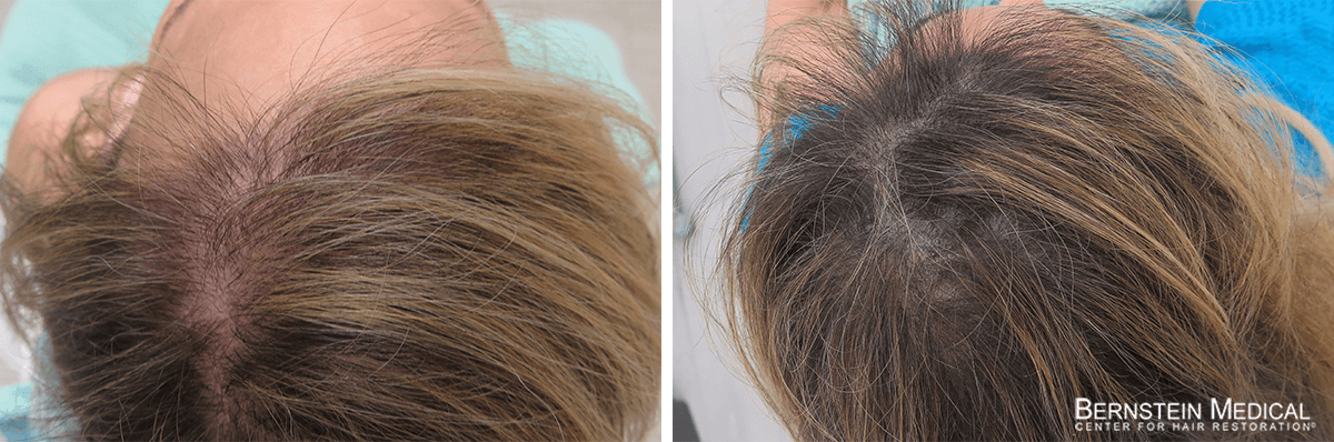 Bernstein Medical - Patient LBY Before and After Hair Transplant Photo 