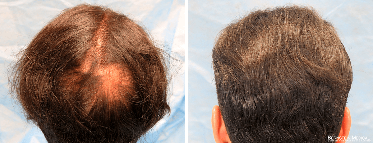 Bernstein Medical - Patient ZNQ – Crown Before and After Hair Transplant Photo 