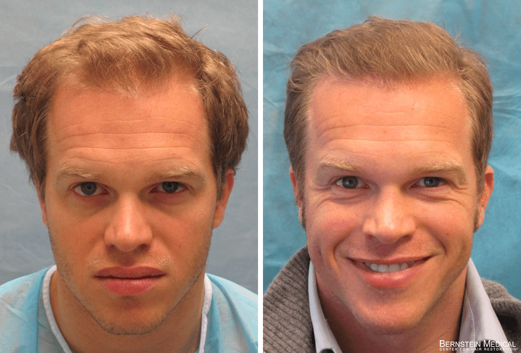 Bernstein Medical - Patient ACM Before and After Hair Transplant Photo 