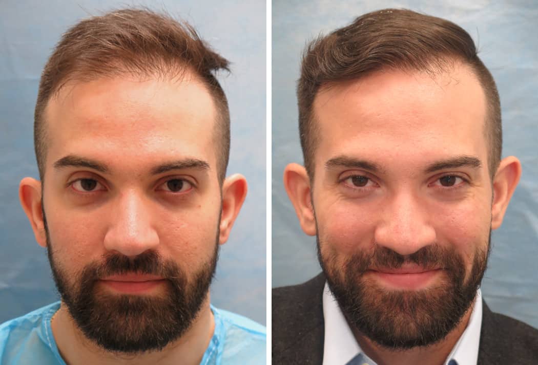 Bernstein Medical - Patient CFQ Before and After Hair Transplant Photo 