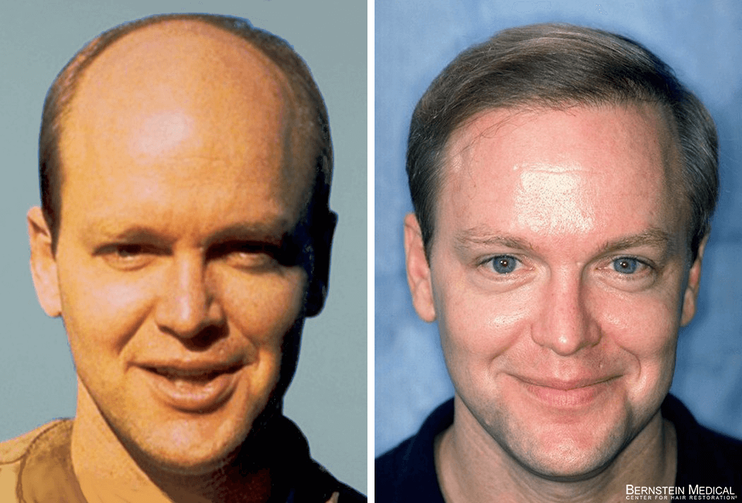 Bernstein Medical - Patient CLF Before and After Hair Transplant Photo 