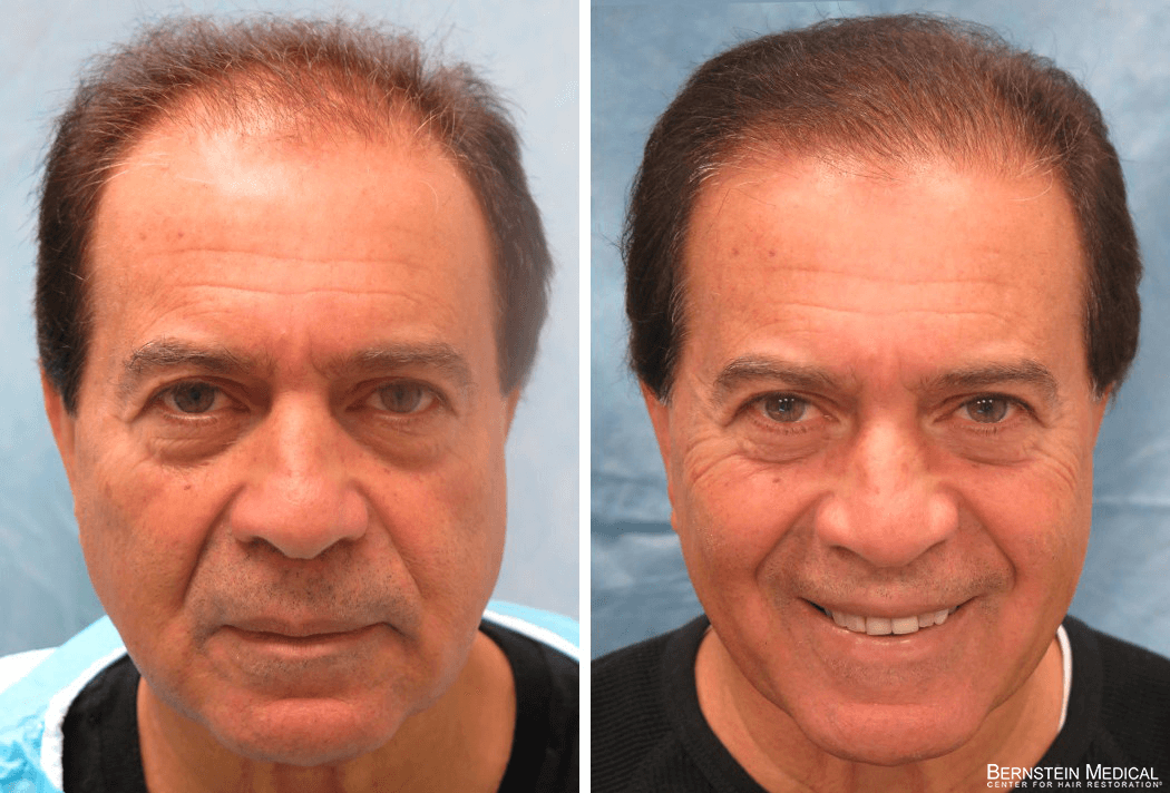 Bernstein Medical - Patient HNZ Before and After Hair Transplant Photo 