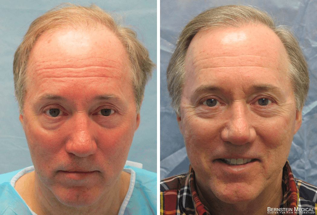 Bernstein Medical - Patient KEB Before and After Hair Transplant Photo 