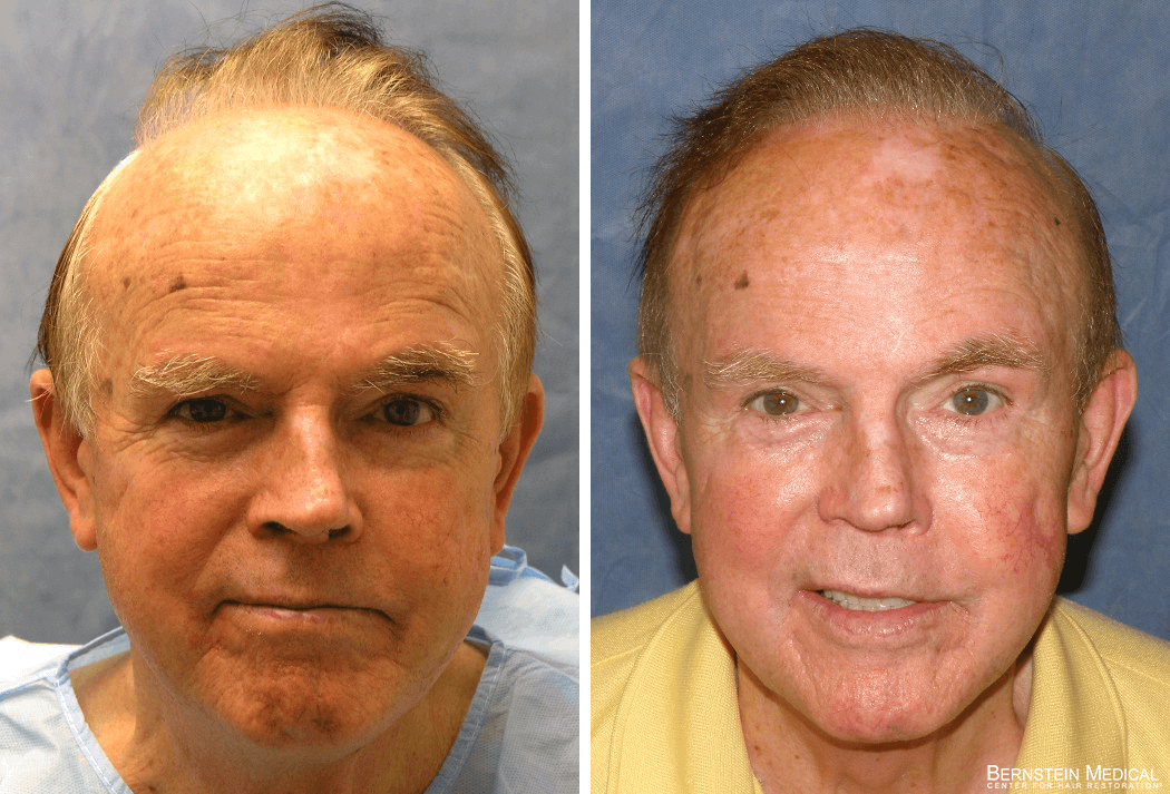 Bernstein Medical - Patient LPL Before and After Hair Transplant Photo 