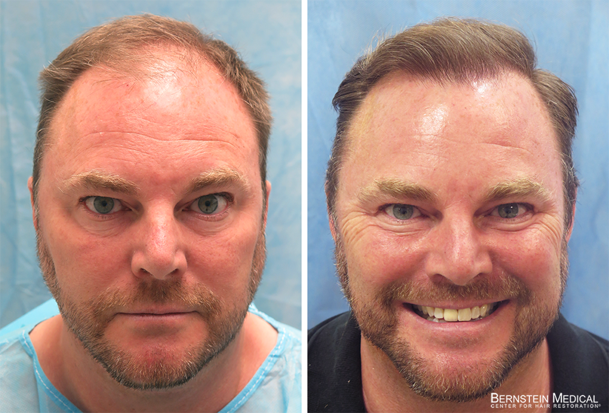 Bernstein Medical - Patient VXB Before and After Hair Transplant Photo 