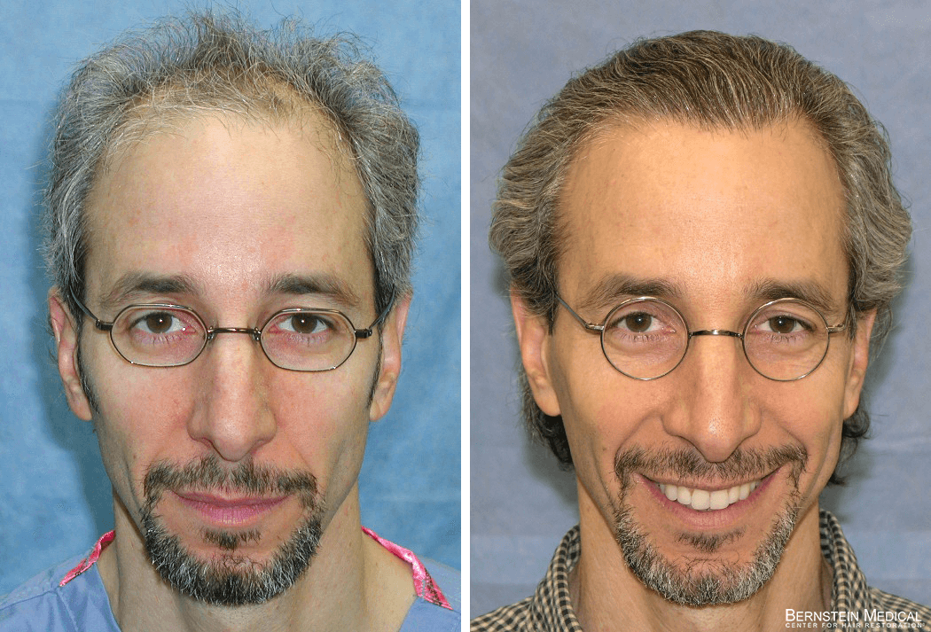 Bernstein Medical - Patient QMR Before and After Hair Transplant Photo 