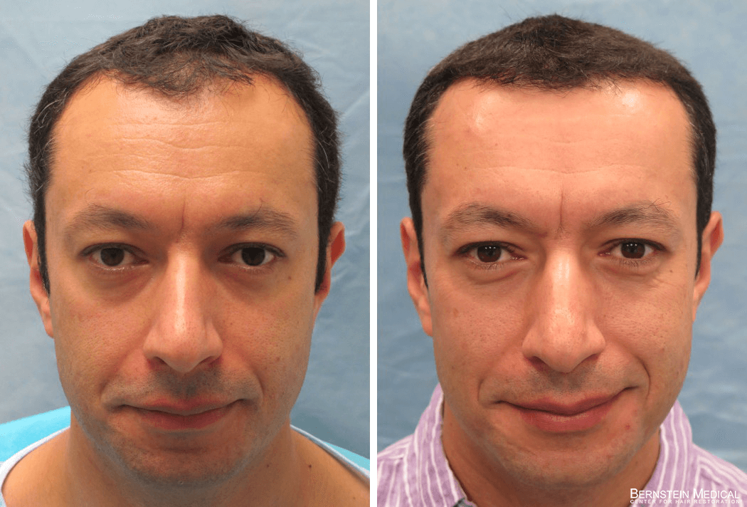 Bernstein Medical - Patient RBL Before and After Hair Transplant Photo 