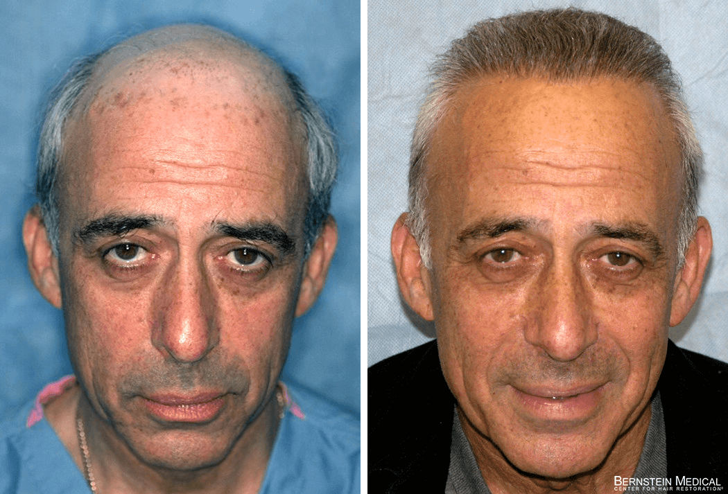 Bernstein Medical - Patient SPB Before and After Hair Transplant Photo 