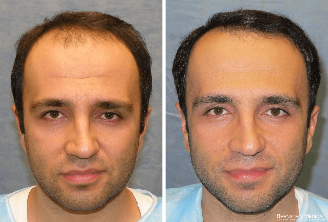 Bernstein Medical - Patient SPD Before and After Hair Transplant Photo 