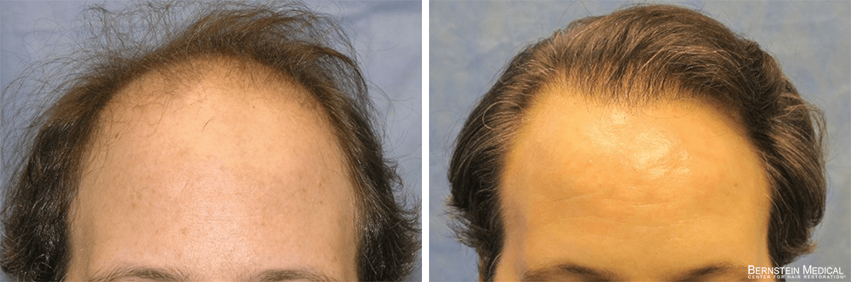 Bernstein Medical - Patient AHO Before and After Hair Transplant Photo 