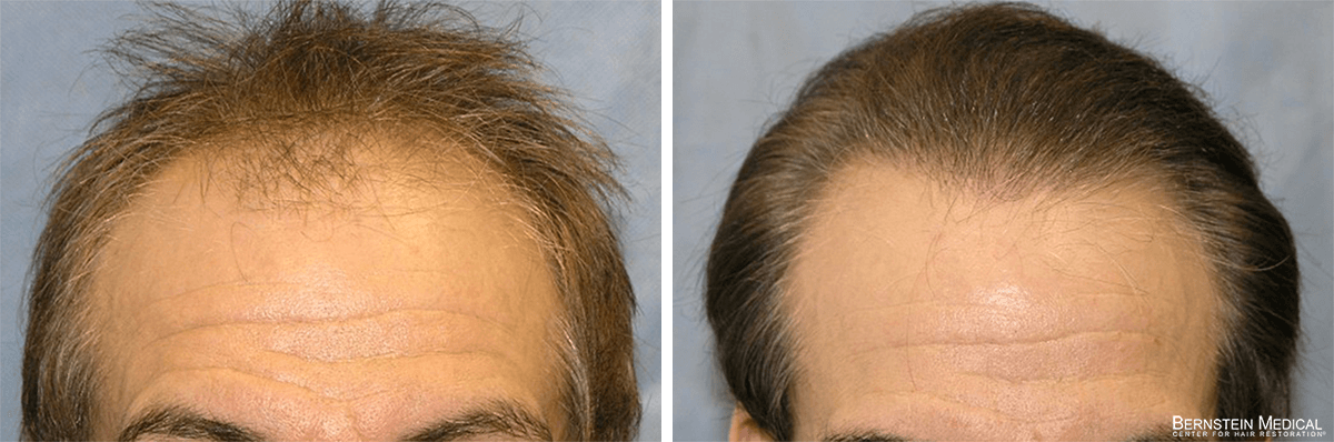 Bernstein Medical - Patient API Before and After Hair Transplant Photo 