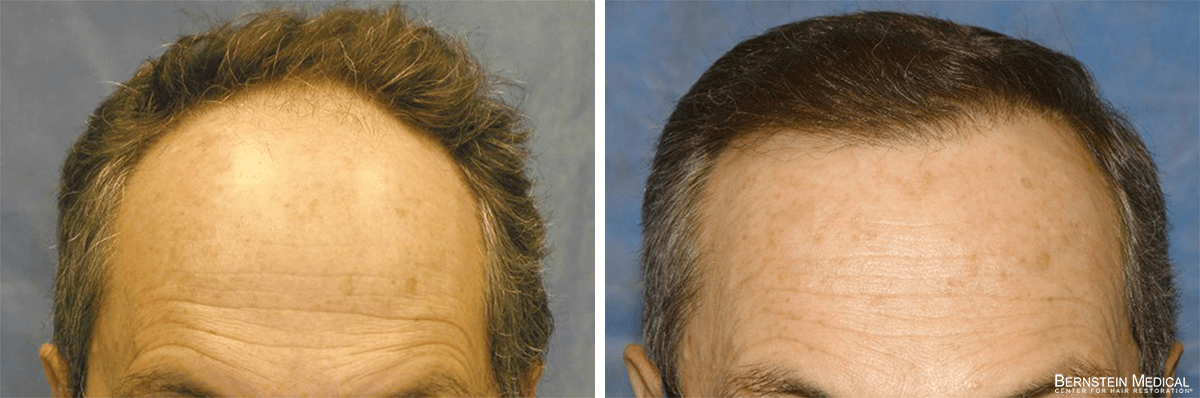 Bernstein Medical - Patient COZ Before and After Hair Transplant Photo 