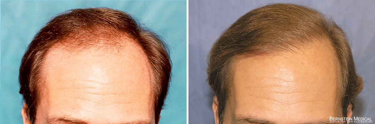 Bernstein Medical - Patient GKR Before and After Hair Transplant Photo 