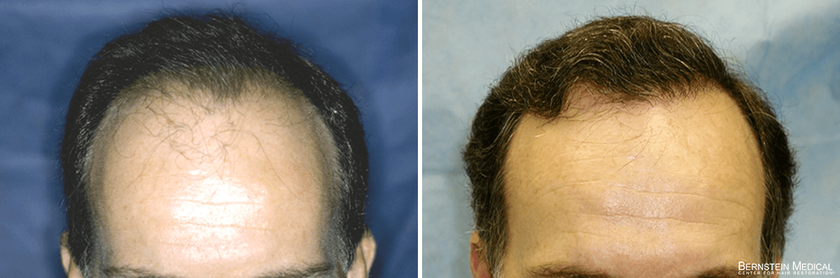 Bernstein Medical - Patient LVC Before and After Hair Transplant Photo 