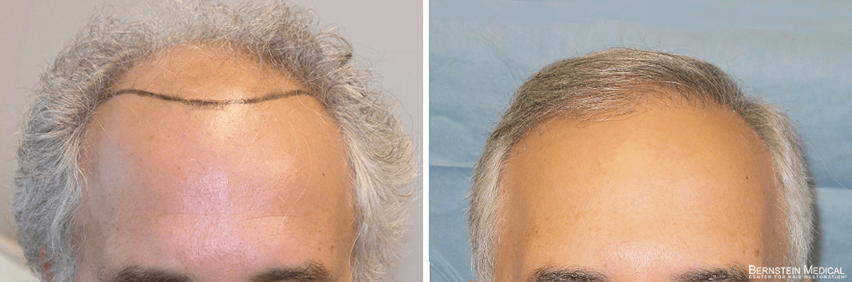 Bernstein Medical - Patient QWI Before and After Hair Transplant Photo 