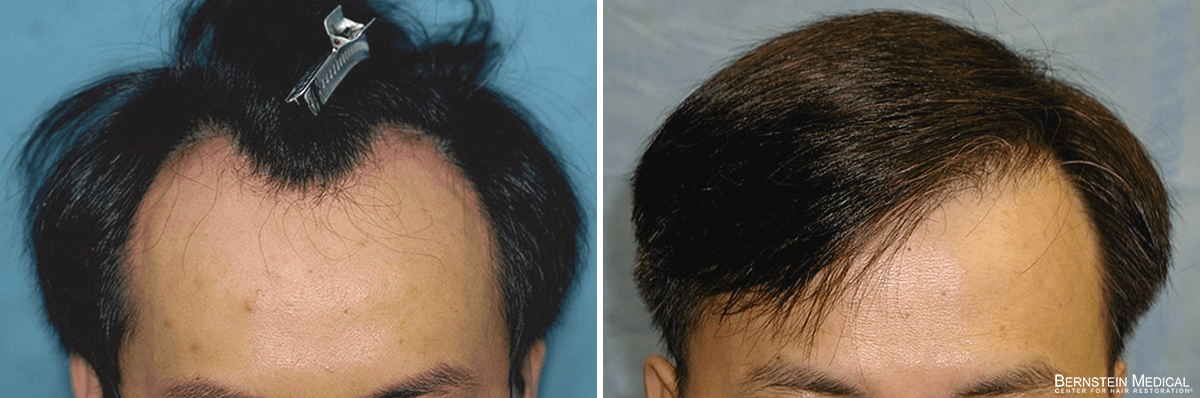 Bernstein Medical - Patient XTW Before and After Hair Transplant Photo 