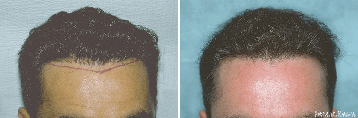 Bernstein Medical - Patient ACS Before and After Hair Transplant Photo 