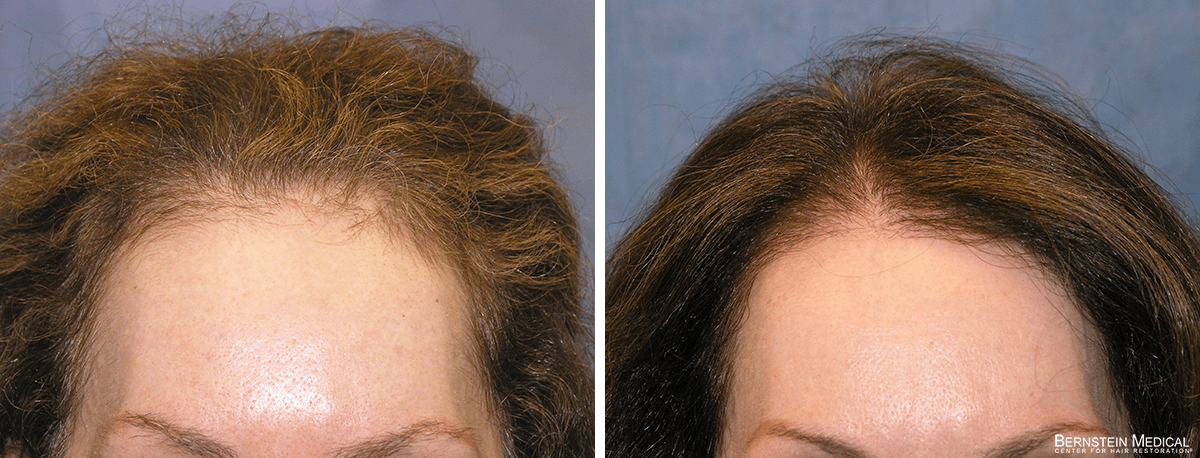 Bernstein Medical - Patient JCA Before and After Hair Transplant Photo 