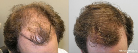 Patient KMJ - 43 y/o male before treatment (left); after 14 months on finasteride 1.25mg/day (right)