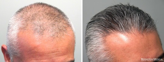 Patient LTF - 47 y/o male before treatment (left); after 1 year on finasteride 1.25mg/day PM (right)