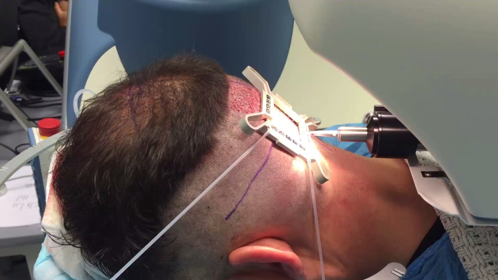 Robotic Donor Harvest Below Occipital Protuberance