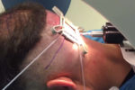 Robotic Donor Harvest Below Occipital Protuberance